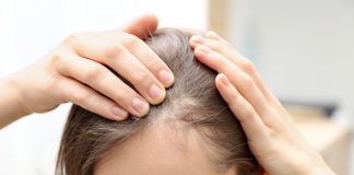 Alopecia areata