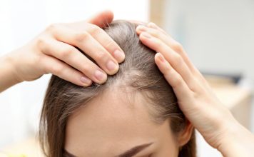 Alopecia areata