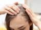 Alopecia areata