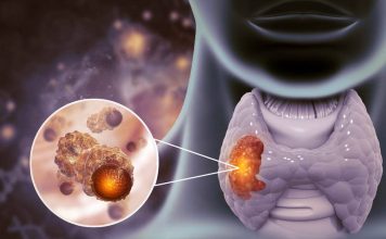 Cancerul: Semne si simptome ce ne trimit la medic