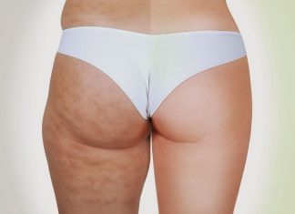 Putem, totusi, scapa de celulita