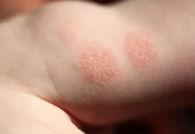 Eczema-cauze si tratament