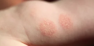Eczema-cauze si tratament