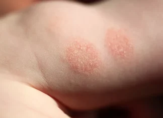 Eczema-cauze si tratament