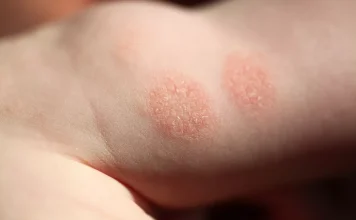 Eczema-cauze si tratament