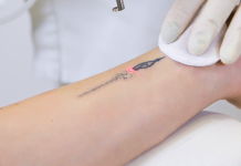 Modalitati de eliminare a tatuajelor