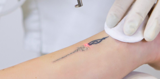 Modalitati de eliminare a tatuajelor