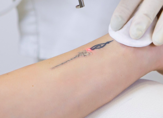 Modalitati de eliminare a tatuajelor
