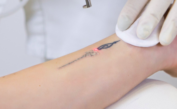 Modalitati de eliminare a tatuajelor