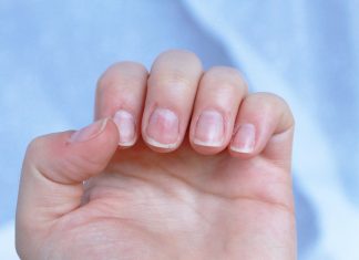 Infectii ale unghiilor si cum sa le evitam