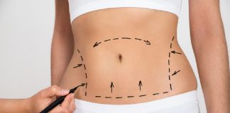 Liposuctia si riscurile ei