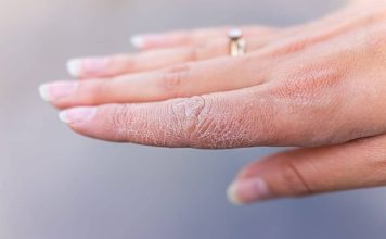 Piele uscata, ce e de facut?