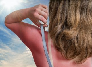 Remedii pentru arsuri solare care functioneaza