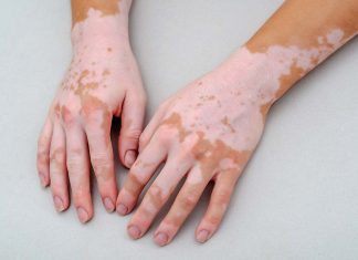 Vitiligo, cauze si tratament